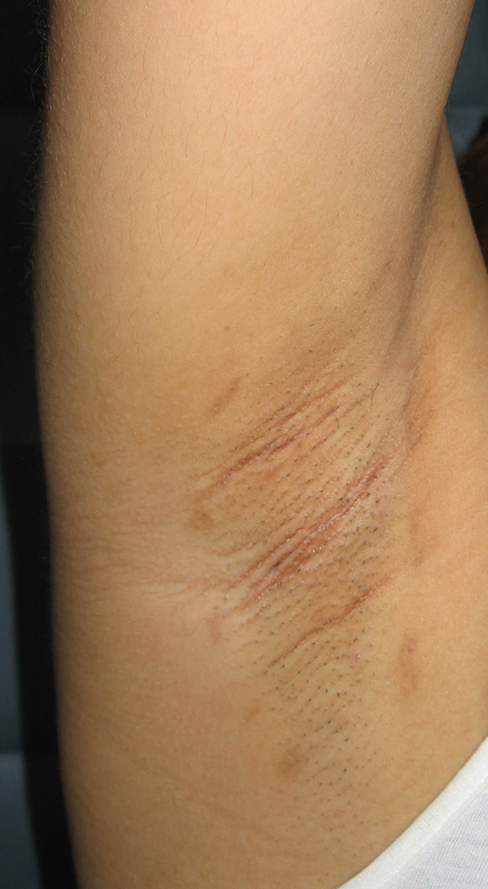 腋臭症 (術後3ヶ月) イメージ