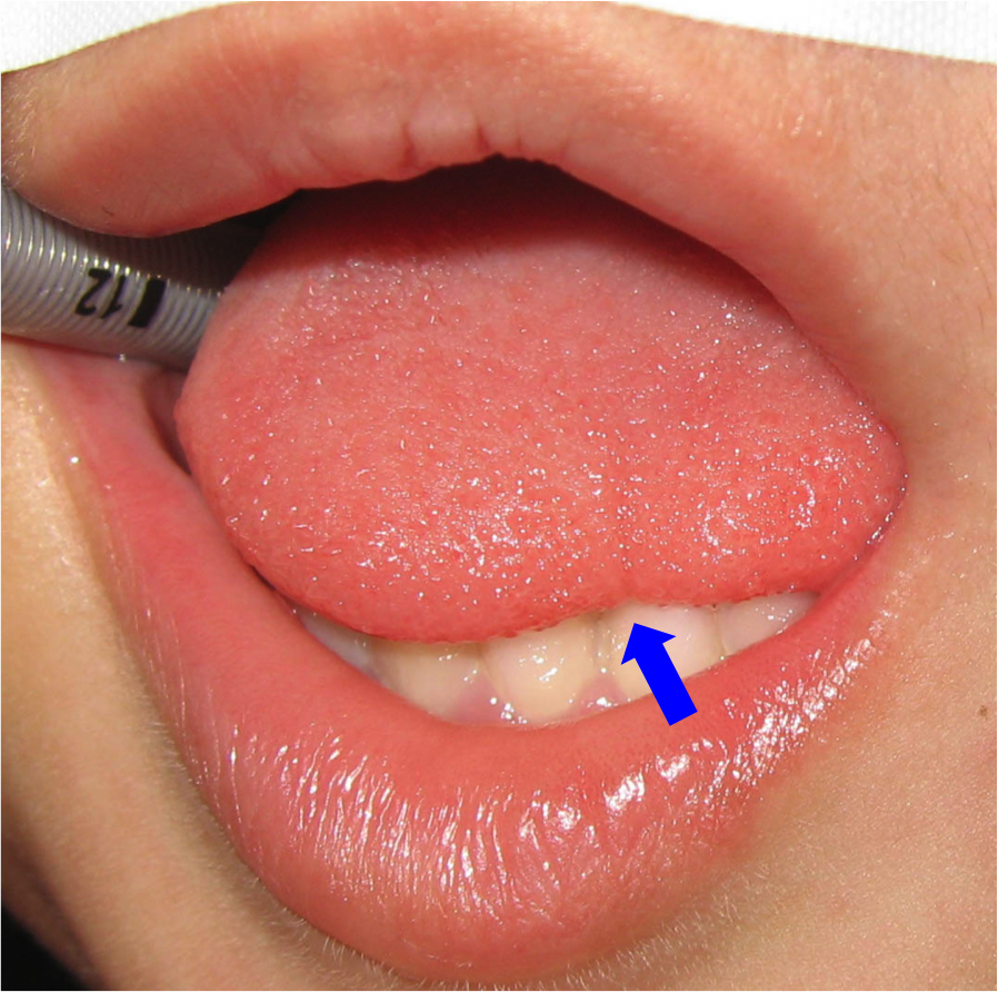 舌小帯短縮症 イメージ