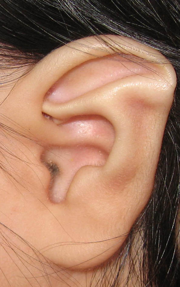 先天性の耳介変形 イメージ
